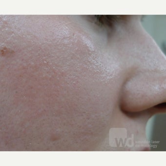 25-34 year old woman treated with Acne Scars Treatment with excellent reduction in pore size. after 1545214