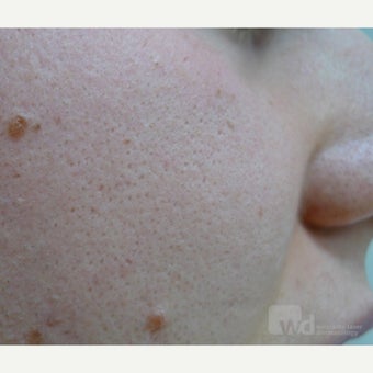 25-34 year old woman treated with Acne Scars Treatment with excellent reduction in pore size. before 1545214