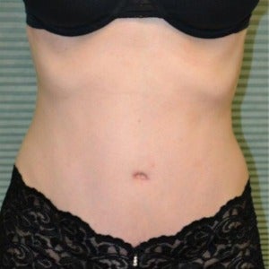 32 year old woman treated with Tummy Tuck after 2130059