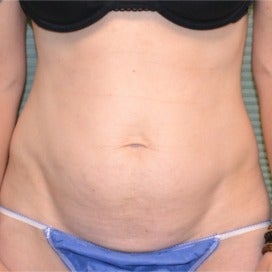 32 year old woman treated with Tummy Tuck before 2130059