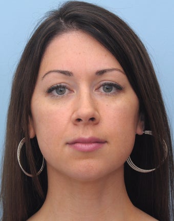 Non-Surgical Chin Augmentation Using Perlane after 658786