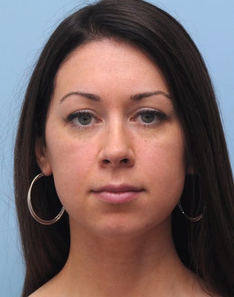 Non-Surgical Chin Augmentation Using Perlane before 658786