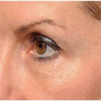 Restylane Under the Eyes Lasts a Long Time - Microcannula Tear Trough Filling after 1747238