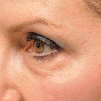 Restylane Under the Eyes Lasts a Long Time - Microcannula Tear Trough Filling before 1747238