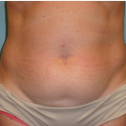 35-44 year old woman treated with Tummy Tuck before 3722300