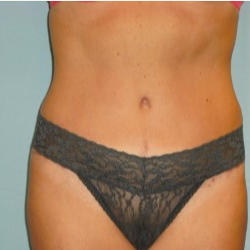 35-44 year old woman treated with Tummy Tuck after 3722300