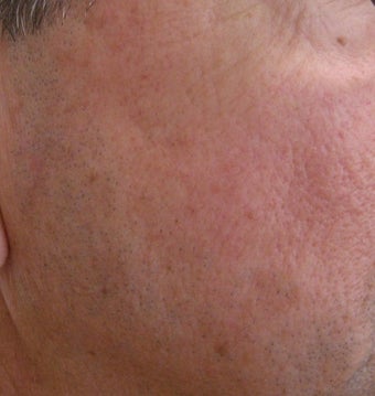 58 year old Male with undesired Pigmentation on face after 694161