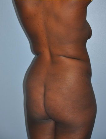 35-44 year old woman treated with "Back Scoop" Liposculpture before 2680087