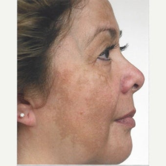 55-64 year old woman treated with Melasma Treatment with Obagi Nu Derm Skin Transformation System before 2579552