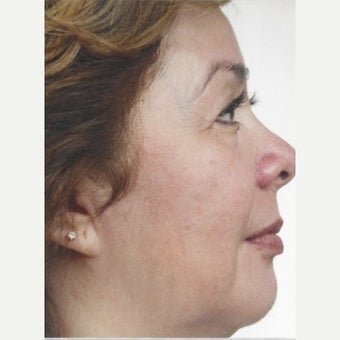 55-64 year old woman treated with Melasma Treatment with Obagi Nu Derm Skin Transformation System after 2579552