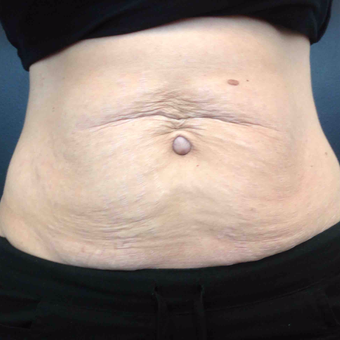 35-44 year old woman treated with Ultherapy before 3071597