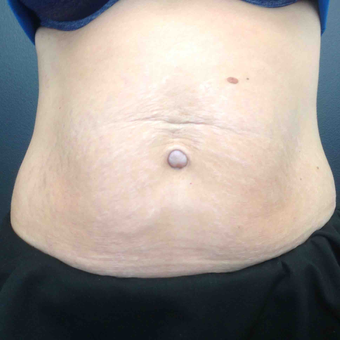35-44 year old woman treated with Ultherapy after 3071597