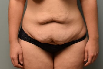 18-24 year old woman treated with Liposuction before 3076845