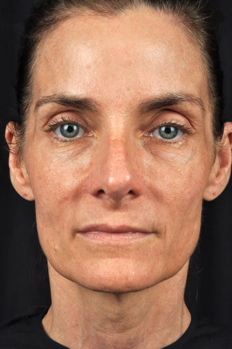 54 year old female with sun damage & loss of volume in face before 1316465