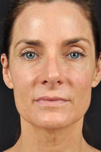 54 year old female with sun damage & loss of volume in face after 1316465