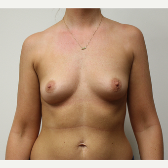 Breast Augmentation before 3417732