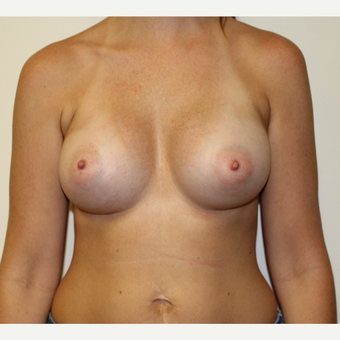 Breast Augmentation after 3417732