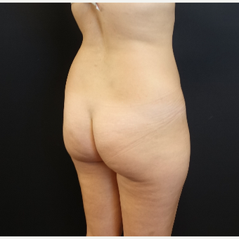 25-34 year old woman treated with Tumescent Liposuction before 3629927