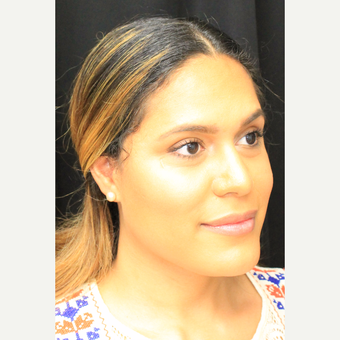 18-24 year old woman treated with Facial Feminization Surgery before 3741547