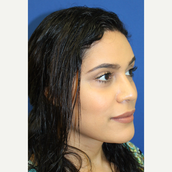 18-24 year old woman treated with Facial Feminization Surgery after 3741547