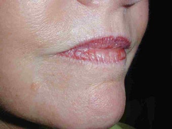 Juvederm and Botox to upper lip before 108816