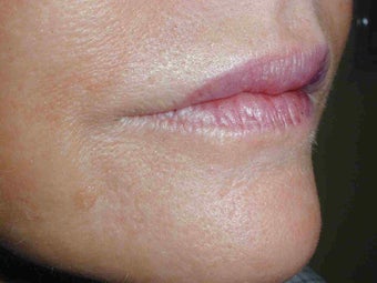 Juvederm and Botox to upper lip after 108816