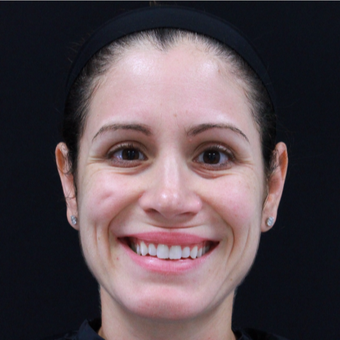 38 year old female treated with Botox before 3724510