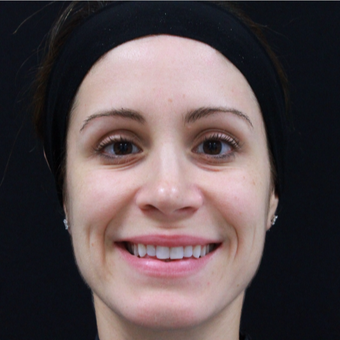 38 year old female treated with Botox after 3724510