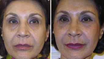 63 year old female treated with a non-surgical facelift before 1101931