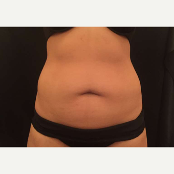 25-34 year old woman treated with CoolSculpting after 3747812