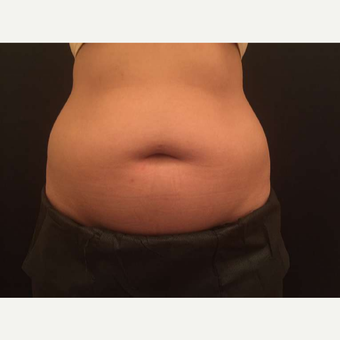 25-34 year old woman treated with CoolSculpting before 3747812