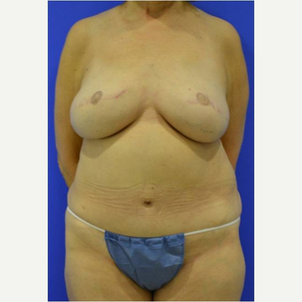 57 year old woman treated with DIEP flap Breast Reconstruction Revision after 3725223