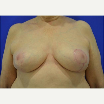65-74 year old woman treated with Breast Reduction after 3727358