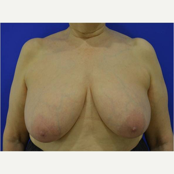 65-74 year old woman treated with Breast Reduction before 3727358