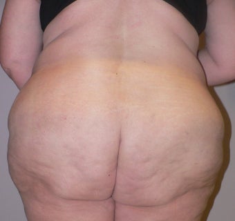 56 year old woman has Belt Lipectomy 984196