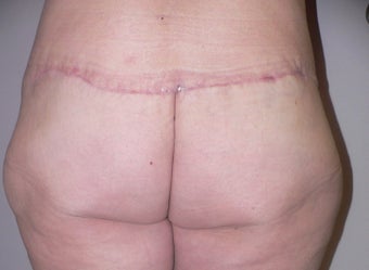 56 year old woman has Belt Lipectomy 984196