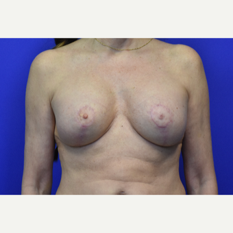 55-64 year old woman treated with Breast Lift after 3326043