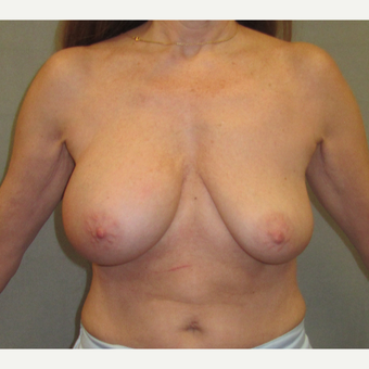 55-64 year old woman treated with Breast Lift before 3326043