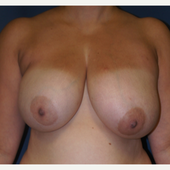 42 year old woman treated with bilateral DIEP flap Reconstruction before 3383388