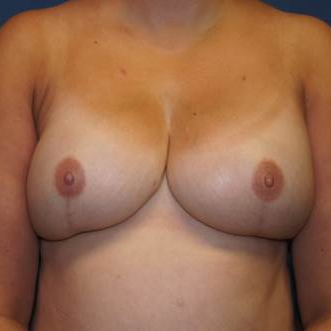42 year old woman treated with bilateral DIEP flap Reconstruction after 3383388