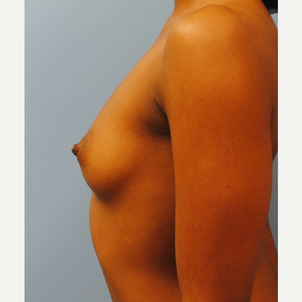 22 year old 5'3", 105 pounds, treated with breast implants, A to D cup, silicone before 3623976