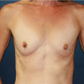35-44 year old woman treated with Breast Implants before 3595783