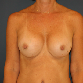 35-44 year old woman treated with Breast Implants after 3595783