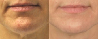 Tightening of the Neck with Sublative and ePrime combination treatment before 1136362