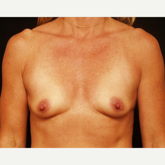 35-44 year old woman treated with Breast Augmentation before 3576320