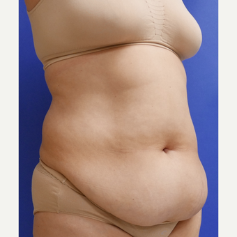 55-64 year old woman treated with Tummy Tuck before 3165565