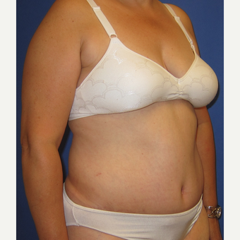 55-64 year old woman treated with Tummy Tuck after 3165565