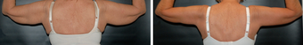 Arm Lift before 1149420