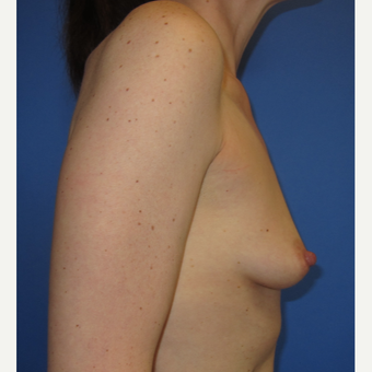 45-54 year old woman treated with Breast Augmentation (R. 286cc, L. 304cc) before 3309898