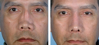 Revision Rhinoplasty before 1208276